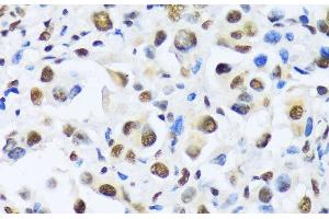 Immunohistochemistry of paraffin-embedded Human lung cancer using OTP Polyclonal Antibody at dilution of 1:100 (40x lens). (OTP Antikörper)