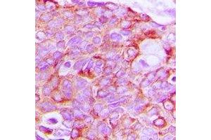 Immunohistochemical analysis of HER3 staining in human breast cancer formalin fixed paraffin embedded tissue section.