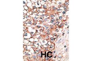 Formalin-fixed and paraffin-embedded human hepatocellular carcinoma tissue reacted with GJA9 polyclonal antibody  , which was peroxidase-conjugated to the secondary antibody, followed by AEC staining. (GJA9 Antikörper  (C-Term))