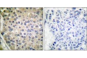 Immunohistochemistry analysis of paraffin-embedded human breast carcinoma, using CPI17 alpha (Phospho-Thr38) Antibody. (CPI-17 Antikörper  (pThr38))