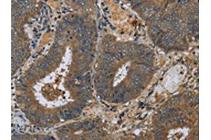 The image on the left is immunohistochemistry of paraffin-embedded Human colon cancer tissue using ABIN7130524(PAEP Antibody) at dilution 1/60, on the right is treated with fusion protein. (PAEP Antikörper)