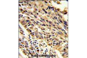 Formalin-fixed and paraffin-embedded human lung carcinoma reacted with TRIP13 Antibody , which was peroxidase-conjugated to the secondary antibody, followed by DAB staining. (TRIP13 Antikörper  (N-Term))