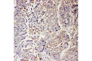 Anti-SLC9A2 antibody, IHC(P) IHC(P): Human Lung Cancer Tissue (SLC9A2 Antikörper  (C-Term))