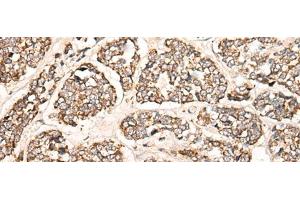 Immunohistochemistry of paraffin-embedded Human esophagus cancer tissue using C1S Polyclonal Antibody at dilution of 1:55(x200) (C1S Antikörper)