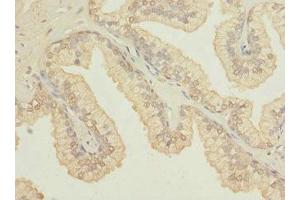 Immunohistochemistry of paraffin-embedded human prostate cancer using ABIN7164612 at dilution of 1:100 (OSGEPL1 Antikörper  (AA 1-270))
