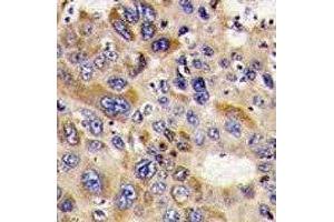 IHC analysis of FFPE human hepatocarcinoma stained with HDAC6 antibody