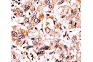 IHC analysis of FFPE human hepatocarcinoma tissue stained with the phospho-Wee1 antibody. (WEE1 Antikörper  (pSer123))