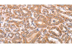 Immunohistochemistry of paraffin-embedded Human thyroid cancer tissue using TRPV4 Polyclonal Antibody at dilution 1:40 (TRPV4 Antikörper)