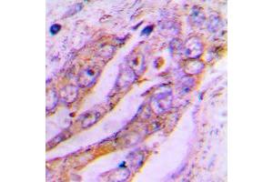 Immunohistochemical analysis of ATP5JL staining in human lung cancer formalin fixed paraffin embedded tissue section.