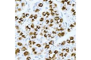 Immunohistochemical analysis of TPPP3 staining in human gastric cancer formalin fixed paraffin embedded tissue section. (TPPP3 Antikörper)