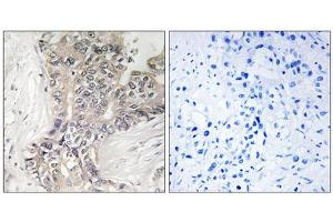 Immunohistochemistry analysis of paraffin-embedded human liver carcinoma tissue using B3GALTL antibody. (B3GALTL Antikörper  (C-Term))