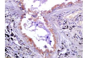 Formalin-fixed and paraffin embedded human lung carcinoma labeled with Anti-LAG-3/CD223 Polyclonal Antibody, Unconjugated (ABIN748508) at 1:200 followed by conjugation to the secondary antibody and DAB staining