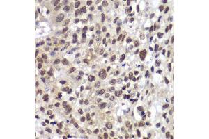 Immunohistochemistry of paraffin-embedded human lung cancer using CHEK2 antibody. (CHEK2 Antikörper  (AA 1-220))