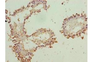 Immunohistochemistry of paraffin-embedded human breast cancer using ABIN7176136 at dilution of 1:100 (ZNF184 Antikörper  (AA 1-751))