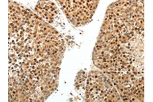 The image on the left is immunohistochemistry of paraffin-embedded Human liver cancer tissue using ABIN7131160(SPATA2L Antibody) at dilution 1/30, on the right is treated with fusion protein. (SPATA2L Antikörper)