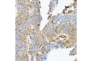 Immunohistochemistry of paraffin-embedded human colon carcinoma using SLC8 Rabbit pAb (ABIN6132664, ABIN6148050, ABIN6148052 and ABIN6221228) at dilution of 1:100 (40x lens).