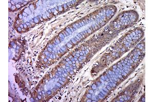 Formalin-fixed and paraffin embedded human colon cancer labeled with BTN2A1 Polyclonal Antibody, Unconjugated (bs-20473R) at 1:200, followed by conjugation to the secondary antibody and DAB staining (BTN2A1 Antikörper  (AA 101-200))