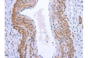 The image on the left is immunohistochemistry of paraffin-embedded Human cervical cancer tissue using ABIN7190847(GPR171 Antibody) at dilution 1/25, on the right is treated with synthetic peptide. (GPR171 Antikörper)