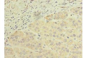 Immunohistochemistry of paraffin-embedded human liver cancer using ABIN7168643 at dilution of 1:100 (SCFD2 Antikörper  (AA 255-470))
