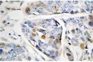 Immunohistochemistry (IHC) analyzes of Lamin A antibody in paraffin-embedded human breast carcinoma tissue. (Lamin A/C Antikörper)
