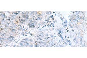 Immunohistochemistry of paraffin-embedded Human colorectal cancer tissue using POMC Polyclonal Antibody at dilution of 1:35(x200) (POMC Antikörper)