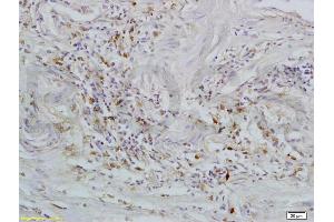 Formalin-fixed and paraffin embedded human rectal carcinoma tissue labeled with Rabbit Anti-GPR30 Polyclonal Antibody (ABIN685717) at 1:200 followed by conjugation to the secondary antibody and DAB staining. (GPER Antikörper  (AA 251-375))