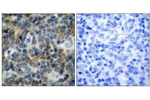 Immunohistochemical analysis of paraffin-embedded human tonsil carcinoma tissue, using VASP (phospho-Ser238) antibody (E011158). (VASP Antikörper  (pSer238))
