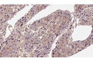 ABIN6276716 at 1/100 staining Human liver cancer tissue by IHC-P. (CD4 Antikörper  (C-Term))