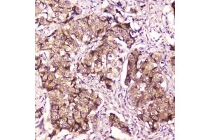 IHC testing of FFPE human breast cancer with p65 antibody at 2ug/ml.