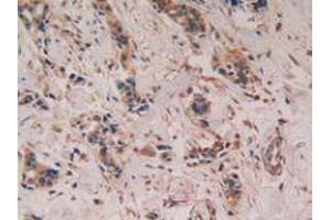 IHC-P analysis of Human Breast Cancer Tissue, with DAB staining. (PTGS2 Antikörper  (AA 418-589))