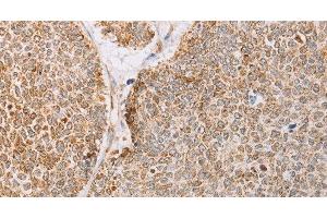 Immunohistochemistry of paraffin-embedded Human lung cancer tissue using YARS2 Polyclonal Antibody at dilution 1:30 (YARS2 Antikörper)
