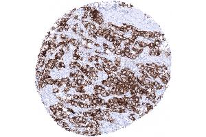 Strong PLAP Immunostaining in all cells of a testicular seminoma. (Rekombinanter PLAP Antikörper)