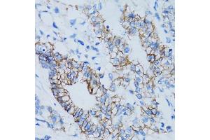 Immunohistochemistry of paraffin-embedded human colon carcinoma using LGALS8 antibody. (LGALS8 Antikörper)