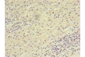 Immunohistochemistry of paraffin-embedded human liver cancer using ABIN7168458 at dilution of 1:100