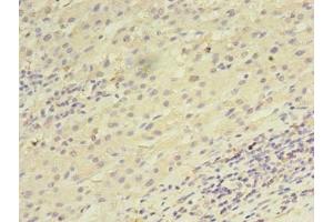 Immunohistochemistry of paraffin-embedded human liver cancer using ABIN7168458 at dilution of 1:100 (UTP23 Antikörper  (AA 1-249))