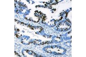 Immunohistochemical analysis of AEBP2 staining in human colon cancer formalin fixed paraffin embedded tissue section. (AEBP2 Antikörper)