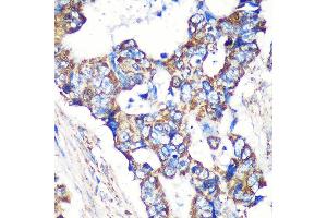 Immunohistochemistry of paraffin-embedded Human colon carcinoma using STNL Rabbit pAb (ABIN7270585) at dilution of 1:100 (40x lens). (STARD3NL Antikörper  (AA 185-234))