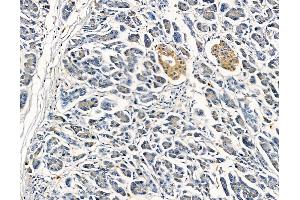 ABIN6260507 and ABIN6279266 at 1/100 staining human gastric cancer by IHC-P. (CATSPERB Antikörper  (C-Term))