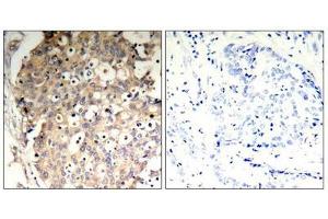 Immunohistochemical analysis of paraffin-embedded human breast carcinoma tissue using SHP-1(Phospho-Tyr536) Antibody(left) or the same antibody preincubated with blocking peptide(right). (SHP1 Antikörper  (pTyr536))