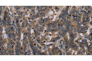 Immunohistochemistry of paraffin-embedded Human liver cancer tissue using FGF18 Polyclonal Antibody at dilution 1:40 (FGF18 Antikörper)