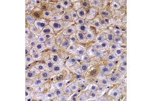 Immunohistochemistry of paraffin-embedded human liver cancer using TCTN3 antibody at dilution of 1:100 (40x lens). (TCTN3 Antikörper)