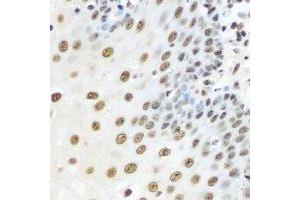 Immunohistochemical analysis of Karyopherin alpha-3 staining in human esophageal cancer formalin fixed paraffin embedded tissue section. (KPNA3 Antikörper)