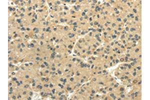 The image on the left is immunohistochemistry of paraffin-embedded Human liver cancer tissue using ABIN7131516(TULP2 Antibody) at dilution 1/20, on the right is treated with fusion protein. (TULP2 Antikörper)