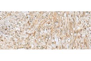 Immunohistochemistry of paraffin-embedded Human liver cancer tissue using NUP58 Polyclonal Antibody at dilution of 1:50(x200)