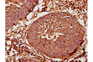IHC image of ABIN7144329 diluted at 1:400 and staining in paraffin-embedded human cervical cancer performed on a Leica BondTM system. (TAP2 Antikörper  (AA 473-615))