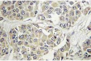 Immunohistochemistry (IHC) analyzes of Tyk 2 antibody in paraffin-embedded human breast carcinoma tissue. (TYK2 Antikörper)