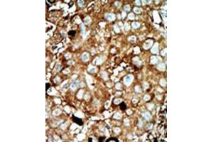 Formalin-fixed and paraffin-embedded human cancer tissue reacted with the primary antibody, which was peroxidase-conjugated to the secondary antibody, followed by AEC staining. (PFKFB3 Antikörper  (C-Term))