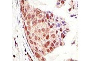IHC analysis of FFPE human breast carcinoma tissue stained with the SUMO antibody (SUMO1 Antikörper  (AA 55-86))