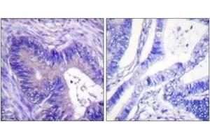 Immunohistochemistry analysis of paraffin-embedded human colon carcinoma, using ATP-Citrate Lyase (Phospho-Ser454) Antibody. (ACLY Antikörper  (pSer455))