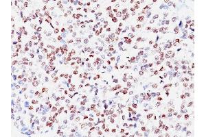 Formalin-fixed, paraffin-embedded human Melanoma stained with MITF Mouse Monoclonal Antibody (SPM290) (MITF Antikörper)